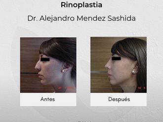 Rinoplastia antes y después - 840762