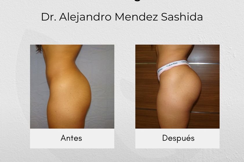 Gluteoplastia antes y después - 840764