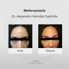 Blefaroplastia - Dr. Alejandro Méndez Sashida