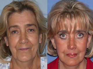 Antes y después de tratamientos faciales