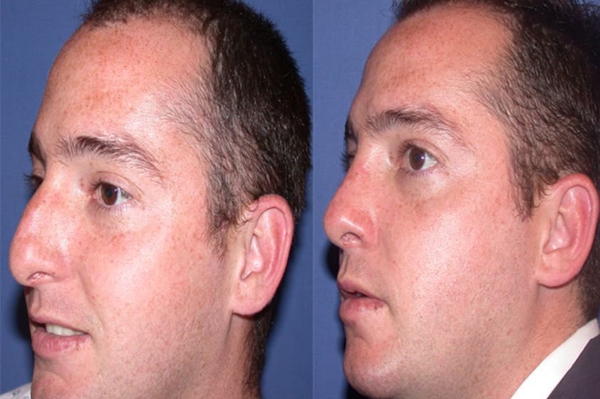 Rinoplastia antes y después - 479918