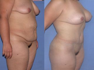Antes y después de abdominoplastía. Dr. Andrade Morales Miguel