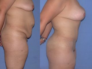 Antes y después de abdominoplastía. Dr. Andrade Morales Miguel