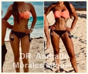 Antes y después de Liposucción - Dr. Andrade Morales Miguel