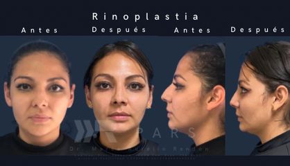 Rinoplastia - Dr. Marco Aurelio Rendón Medina PARS