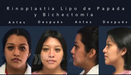 Rino + bichectomia + lipo de papada - Dr. Marco Aurelio Rendón Medina PARS