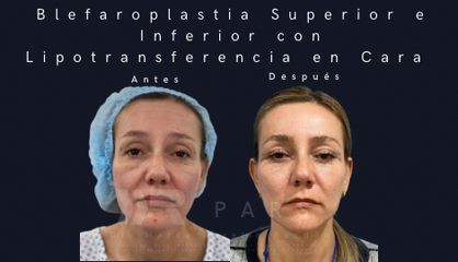 Blefaroplastia y Lipo transferencia en cara - Dr. Marco Aurelio Rendón Medina PARS