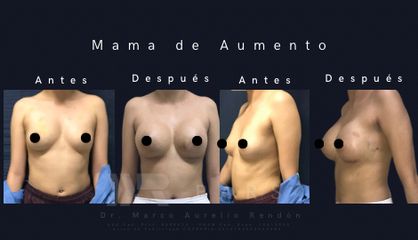Aumento mamario con implantes - Dr. Marco Aurelio Rendón Medina PARS