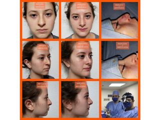 Antes y después de Rinoplastía + Mentoplastía