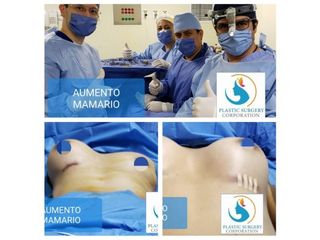 Antes y después de Aumento mamario