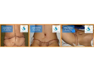 Antes y después de Abdominoplastia