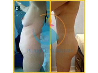 Antes y después de Abdominoplastia