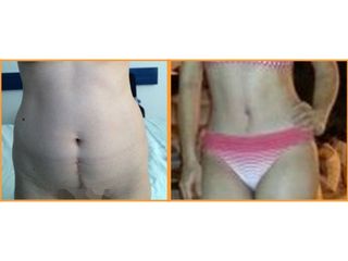Antes y después de  Abdominoplastia