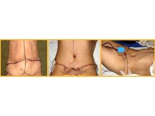 Antes y después de Abdominoplastia