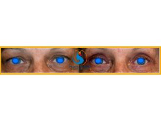 Blefaroplastia - 642366