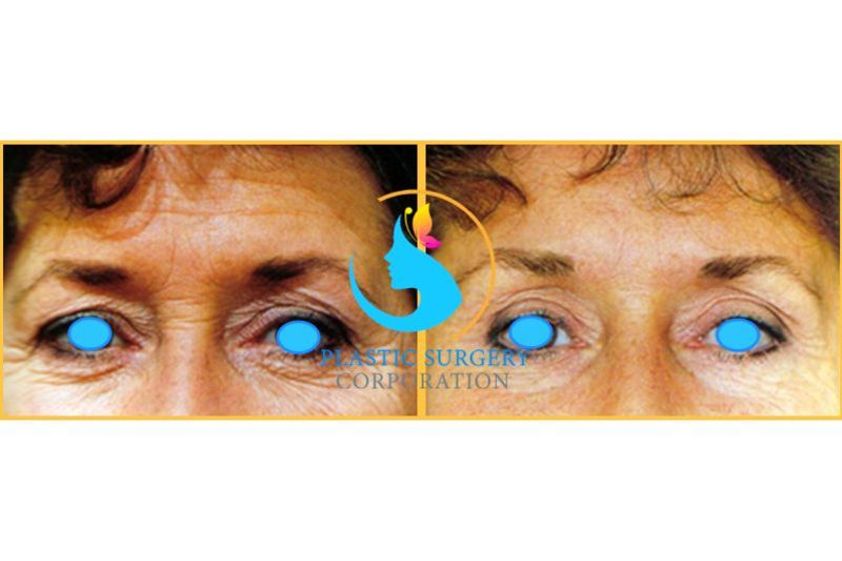 Blefaroplastia antes y después - 642367