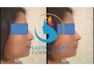 Rinoplastia