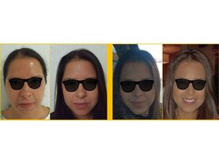 Antes y después de Rinoplastia + Bolsas de bichat