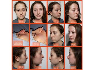 Antes y después de Rinoplastía, Mentoplastia y bichectomia