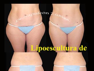 Antes y después de Lipoescultura de cintura y caderas