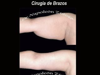 Antes y después de Cirugia de Brazos braquioplastia