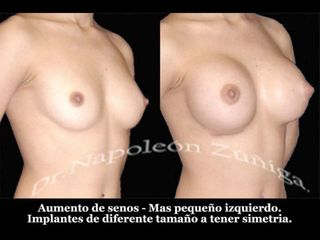 Antes y después de aumento de busto