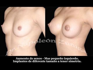 Antes y después de aumento de busto