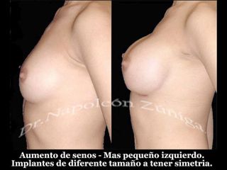 Antes y después de aumento de busto