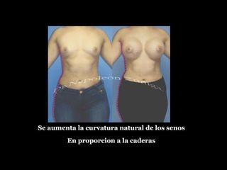 Antes y después de aumento de busto