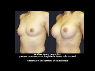 Antes y después de Aumento de busto