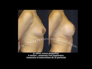 Antes y después de Aumento de busto