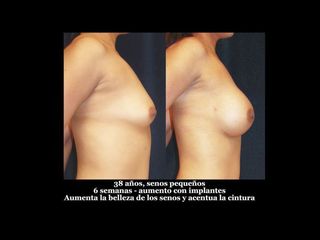Antes y después de Aumento de busto