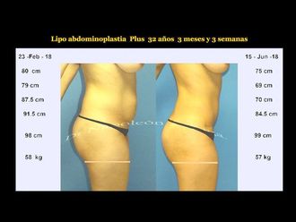Abdominoplastia - 638607