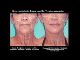 Antes y después de Lifting de cara y cuello