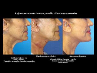 Antes y después de Lifting de cara y cuello