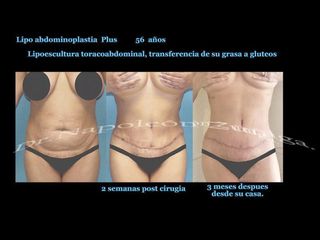 Antes y después de Lipoescultura