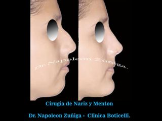 Antes y después de Cirugia de Nariz y Menton