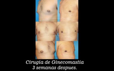 Antes y después de Cirugía de ginecomastia