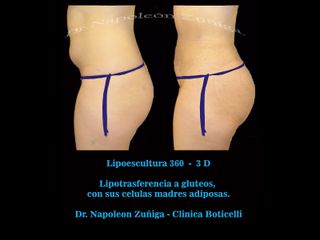 Antes y después de Lipoescultura 3 D y Lipotrasferencia 