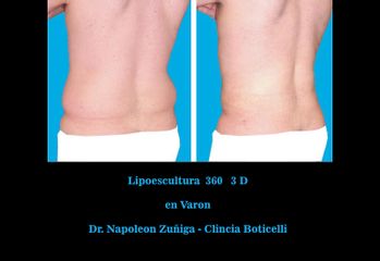 Antes y después de Lipoescultura en varón