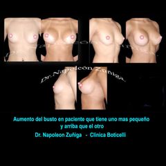 Antes y después deAumento de busto