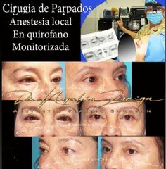 Antes y después de  Blefaroplastia - Dr. José Napoleón Zúñiga Sánchez