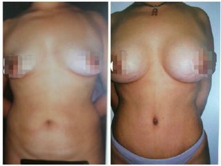 Antes y después Abdominoplastia y aumento de busto