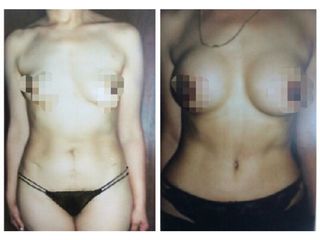 Antes y después Abdominoplastia y aumento de busto