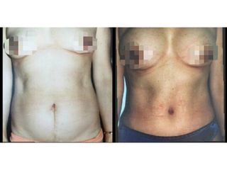 Antes y después Abdominoplastia