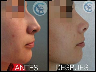 Antes y después Rinoplastia