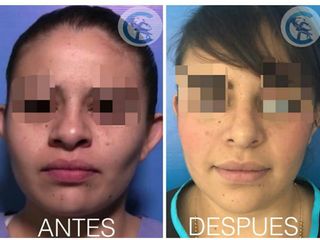 Antes y después Rinoplastia