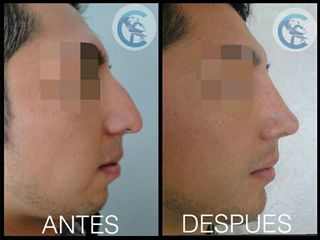 Antes y después Rinoplastia