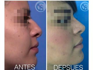 Antes y después Rinoplastia