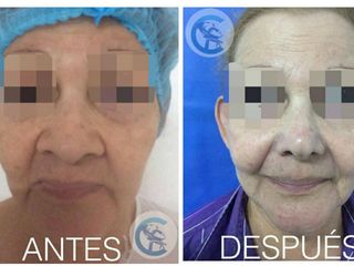 Antes y después Rinoplastia